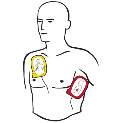 How to use an AED demonstration cartoon man with electrode pads on his chest. 