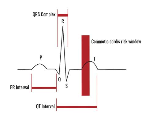 Heart rhythm showing commotio cordis risk window. 